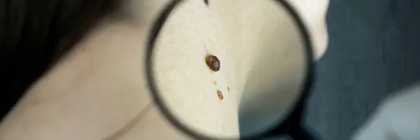 Skin Tag Removal treatment
