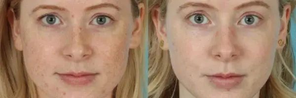 IPL Photofacial treatment