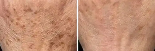 Laser Pigmentation Removal treatment