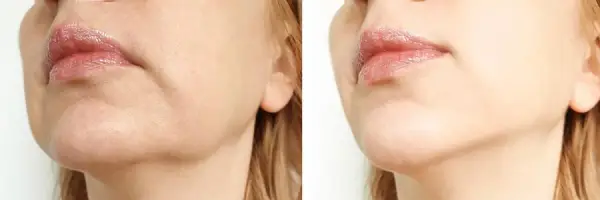 Laser Skin Tightening treatment