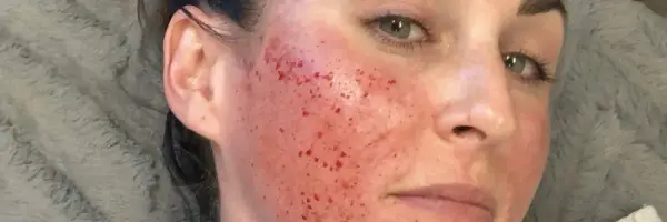 Microneedling treatment